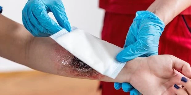 Yaralarda Ozon Uygulaması